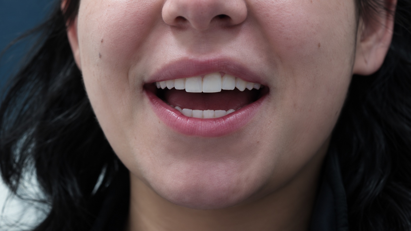 Un segundo ángulo de la sonrisa de la paciente.
